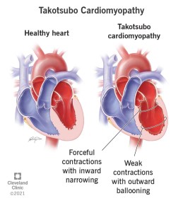 22022-takotsubo-cardiomyopathy